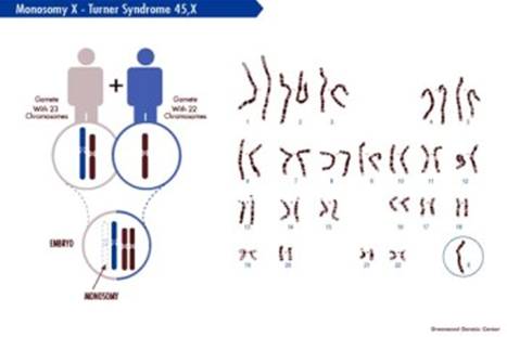 turner-syndrom-45xo